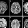 How errors in the cytoskeleton lead to a smaller brain